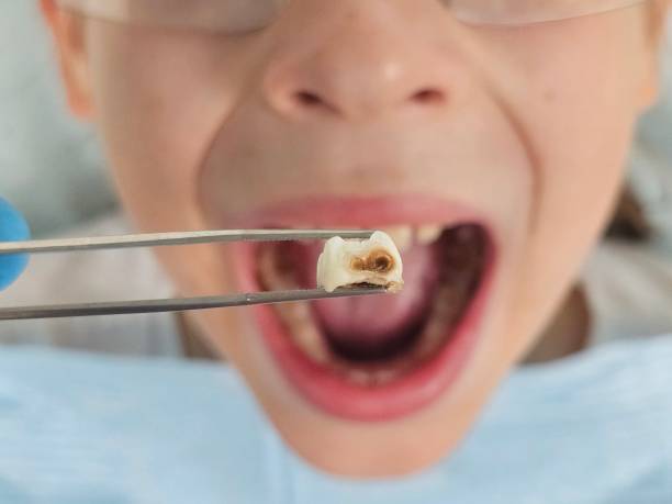 Best Emergency Dental Care for Broken or Chipped Teeth in Troy, MO